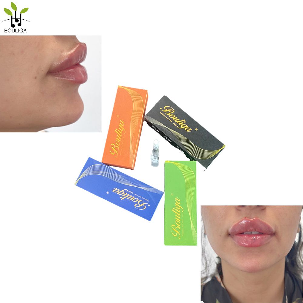 Bouliga Hautfüller 2 ml 100 % Hyaluronsäure 20 mg/ml Konzentration für Lip Glow Up